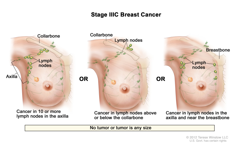 Figure, Stage IIIC breast cancer. No] - PDQ Cancer Information Summaries  - NCBI Bookshelf