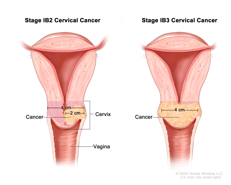 WHO Rwanda on X: Do you know the symptoms of #cervicalcancer? Here is what  to look out for: ✓Irregular or postmenopausal bleeding ✓Increased vaginal  discharge ✓Pain during sex ✓Vaginal bleeding after sex #