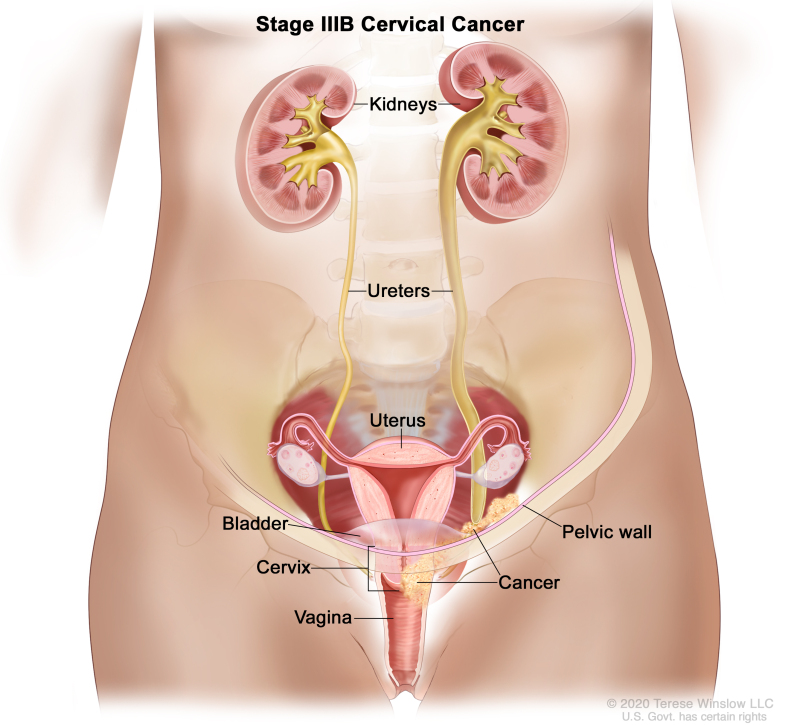 Stage One signs of cervical cancer? Symptoms Vaginal bleeding