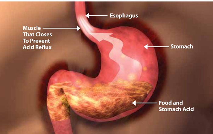 Can acid reflux cause asthma like symptoms