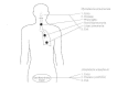 Figure 37-4. Pathogenesis and disease sites of infection by M pneumoniae and U urealyticum.