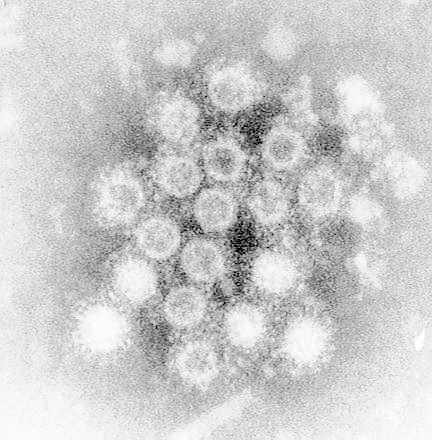 Figure 70-2. Immune aggregate of hepatitis A virus following the addition of convalescent serum to a fecal extract during the acute phase of the illness X 400,000 (from a series by Anthea Thornton and A J Zuckerman).