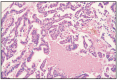Fig. 11.9. Papillary adenocarcinoma, simple type.