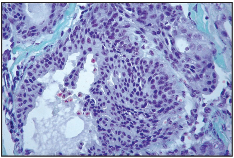 Fig. 13.29. Urinary bladder adenocarcinoma.