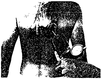 Measurement of subscapular skinfold.