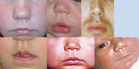 what is the purposes of the philtrum