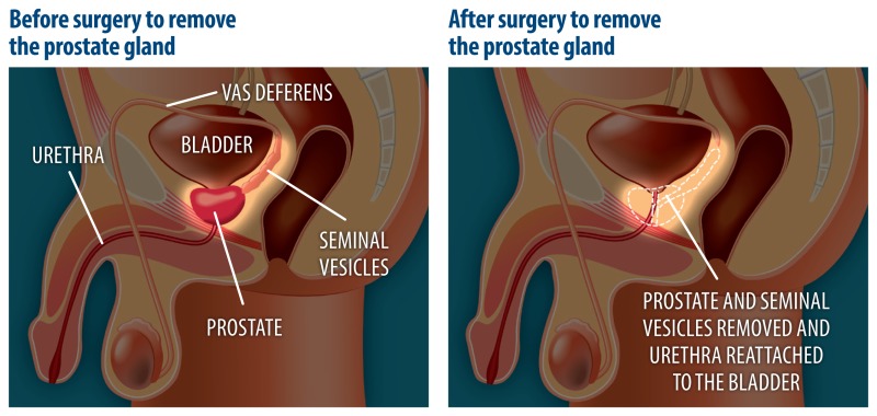 prostate cancer treatment ncbi)